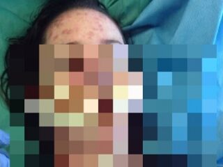 「スティーブンス・ジョンソン症候群」薬の副作用で美少女の姿が変わり果てる悲劇!!