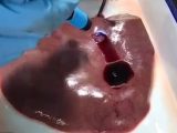 【動画アリ】どんな傷でも20秒で完全止血する「バイオ接着剤」爆誕! 心臓の傷も余裕… 失血死根絶へ!=中国