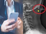 【恐怖】スマホのしすぎで人類の頭蓋骨が変形していることが判明! 後頭部に謎の突起が出現中!