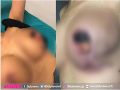 豊胸手術で“最悪の失敗”に陥った女性の画像が悲惨！ 「病院を信じてください」→ おっぱいが壊疽して切除するハメに… ＝タイ