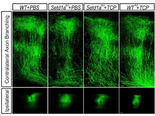 統合失調症を劇的改善する薬がついに発見される！ まさかの「●●病」治療薬で脳が復活すると判明