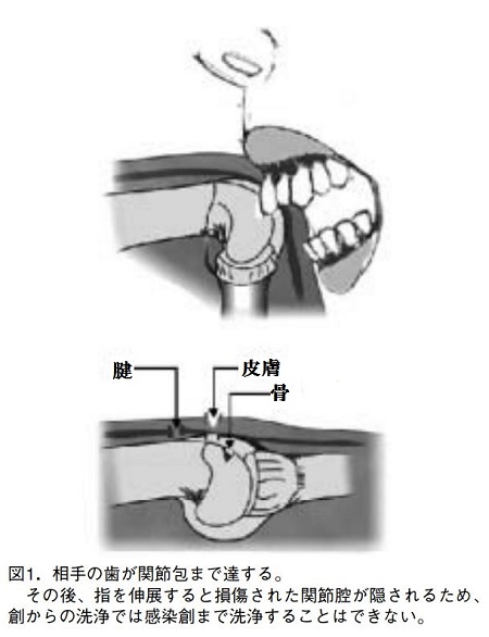 【新型コロナの感染】最もヤバイのは「手を噛まれる」ことだった！ 最凶の攻撃「ヒト咬傷」を亜留間次郎が解説…骨が溶けた例も！の画像4