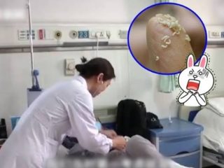 体内で2センチに成長……「がんが治る」民間療法を信じた中国人女性、肺や腸が数千匹の蛆虫に侵食される