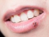 キスでヘルペスをうつされた男性が損害賠償を求めて女性を提訴! ショックのあまり卒倒、パニック発作まで発症し… 感染症訴訟が増加の危機!?