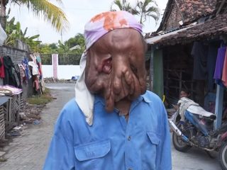 頭全体が巨大腫瘍になった男の壮絶エピソードに号泣必至!! 滲む体液、手術失敗、肉親の死、貧困… 村人の愛に支えられ＝インドネシア