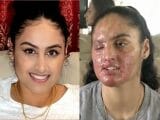 アシッドアタックで顔面が溶けた美人女子大生! アジア系に対する憎悪と戦い抜く覚悟=米