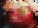 「810万円分の胃袋」持つ女を病院で開腹した結果…! 異食症患者が抱える深刻な問題とは!?