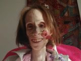 20年以上「拒食症」と誤診され続けた女性の意外な真実! 善意に支えられ難病に立ち向かう=英
