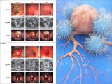 【朗報】大腸がんが「100%消滅した」夢のような新薬ついに登場! 世界が歓喜する画期的治験結果 (最速ニュース)