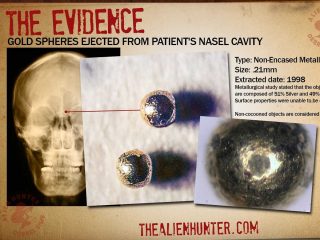 エイリアンインプラント研究最前線が凄い！ 元CIA職員が医師会で発表、4つの重大な知見