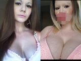 世界最大の「タラコ唇」!? 唇へのヒアルロン酸注射を30回繰り返した女性が完全に別人化!