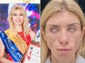 整形失敗で目を閉じられなくなったブロンド美女！ 笑顔も作れずうつ病に…