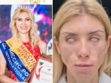 整形失敗で目を閉じられなくなったブロンド美女! 笑顔も作れずうつ病に…