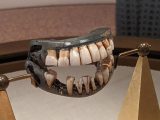 人類最初の臓器売買「歯買取ビジネス」の恐怖! 死体、奴隷、貧者から歯を抜き取り…(亜留間次郎)