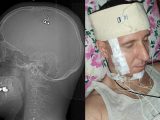 素人が自分自身に脳外科手術を敢行! ロシアのリアルブラックジャックに医師が警鐘を鳴らす