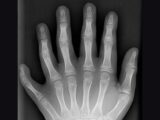 多指症にまつわる伝説が世界中に多い謎! 古代壁画、未知の部族、シュメール文明、ネフィリム遺骨… 人類史に重要な役割か