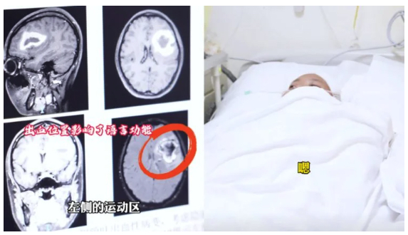突如「特定の言語だけ話せなくなった」24歳女性襲った謎の病の画像2