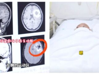 突如「特定の言語だけ話せなくなった」24歳女性襲った謎の病