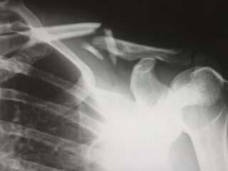 「一度も骨折したことがない人」にまつわる奇妙な説…それは単なる幸運ではない？
