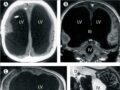 脳の90％が欠けていた男性が「普通に暮らしていた」──科学の常識を覆す驚愕の事例