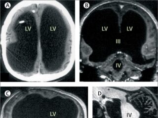 脳の90％が欠けていた男性が「普通に暮らしていた」──科学の常識を覆す驚愕の事例