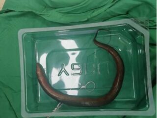 激しい腹痛で運ばれた男性の体内から“内臓の間”を泳ぐ「30cmの生きたウナギ」が…！
