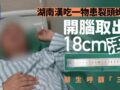 脳から18cmの「生きた虫」！ 数年前の“生食”が招いた悪夢の正体
