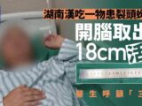 脳から18cmの「生きた虫」！ 数年前の“生食”が招いた悪夢の正体