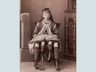 “四本足の少女”見世物にされながらも愛と家族を手にし、幸せに生きた女性の実話