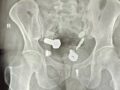 【衝撃X線】男性の胃から摘出された「ありえない異物」