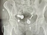 【衝撃X線】腹痛の原因は“腕時計”と“大量のネジ” ― 男性の胃から摘出された「ありえない異物」