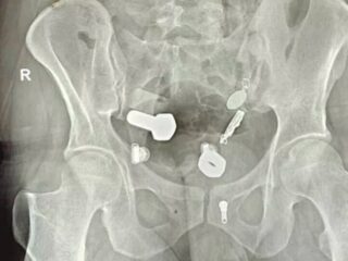 【衝撃X線】腹痛の原因は“腕時計”と“大量のネジ” ― 男性の胃から摘出された「ありえない異物」