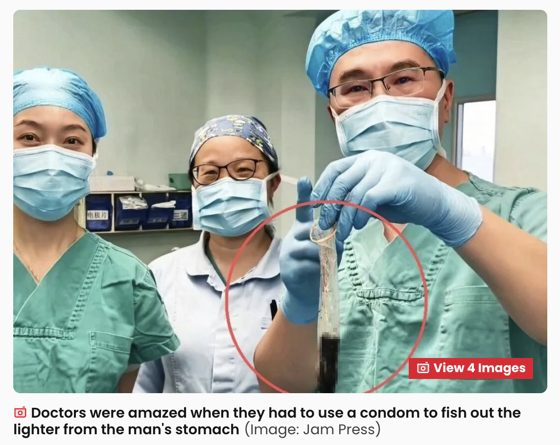 胃の中から“30年前のライター”を摘出！滑って掴めない… 医師が頼った「意外すぎる秘密兵器」の画像2