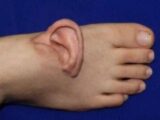 5ヶ月間、“足に耳を移植”して生活した女性、奇跡の再接着手術に成功