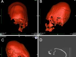 まるでエイリアン… クロアチアで発見された「奇妙に伸びた頭蓋骨」を持つ少年の正体とは