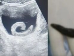 ネットで見つけた民間療法を信じて膀胱に「生きたヒル」を入れた男性の末路