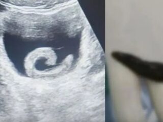 ネットで見つけた民間療法を信じて膀胱に「生きたヒル」を入れた男性の末路