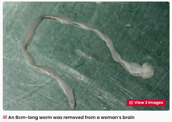 カエルの脚で「虫歯」を治そうとした結果… 女性の脳から8センチの生きた寄生虫が！ 戦慄の医療ミステリーの画像2
