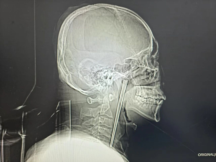 喉に12センチの「金属製の箸」が刺さったまま8年間放置! 中国のトンデモ患者が手術を拒否し続けた理由の画像1