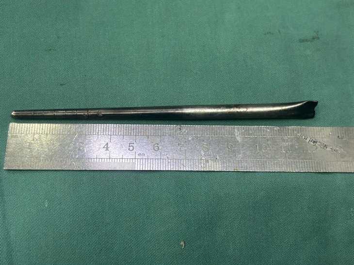 喉に12センチの「金属製の箸」が刺さったまま8年間放置! 中国のトンデモ患者が手術を拒否し続けた理由の画像2