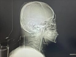 喉に12センチの「金属製の箸」が刺さったまま8年間放置！ 中国のトンデモ患者が手術を拒否し続けた理由