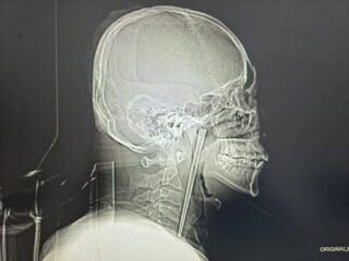 喉に12センチの「金属製の箸」が刺さったまま8年間放置！ 中国のトンデモ患者が手術を拒否し続けた理由