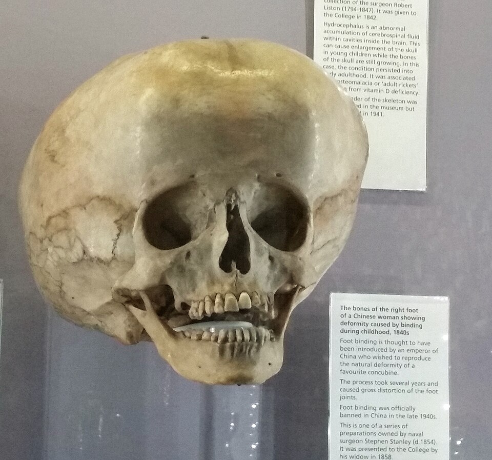 “宇宙人とのハイブリッド”と噂される「スターチャイルド・スカル」の謎とDNA鑑定の衝撃結果の画像2